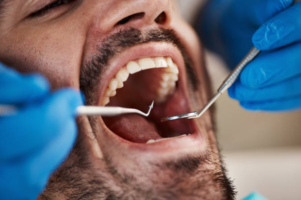 Best Lost Filling or Crown Replacement in Martinsvle, IL